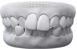 crowded-teeth