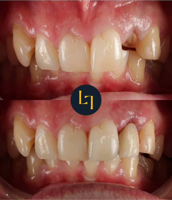 Dental crowns before and after — strengthening a heavily filled tooth
