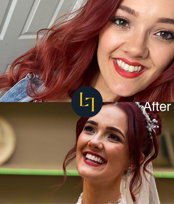 Invisalign case — crowding reduced for a neater smile