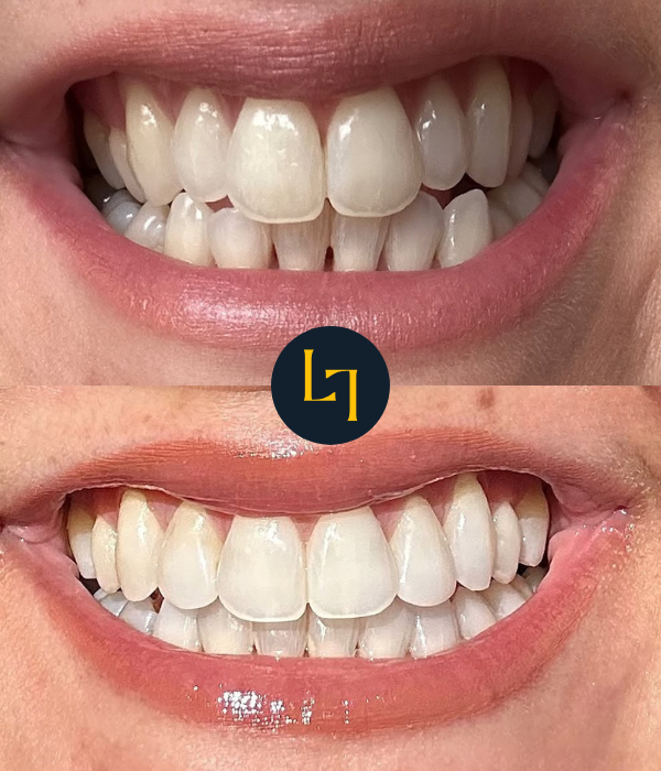 invisalign before and after photo - 11
