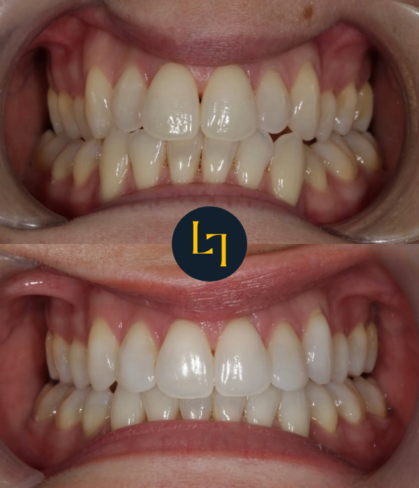 invisalign before and after photo - 12