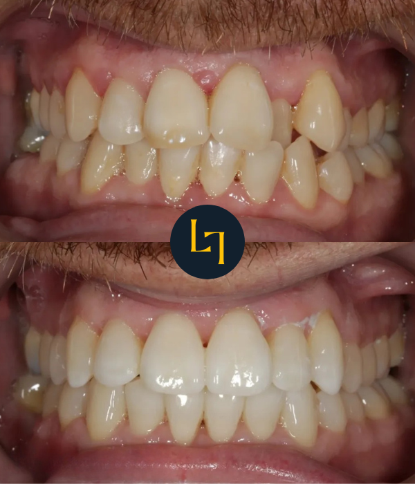 invisalign before and after photo - 7