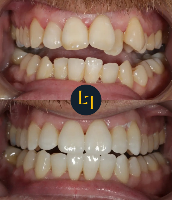 invisalign before and after photo - 8