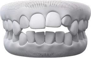 open-bite