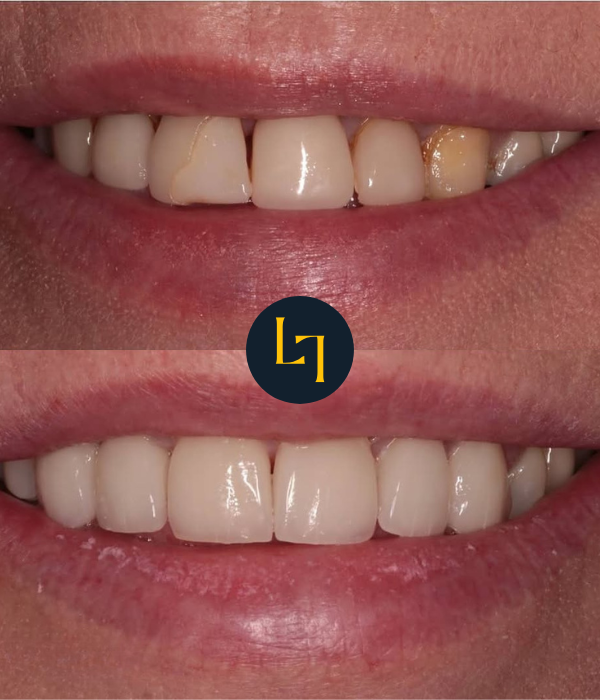 porcelain veneers before and after photo 3