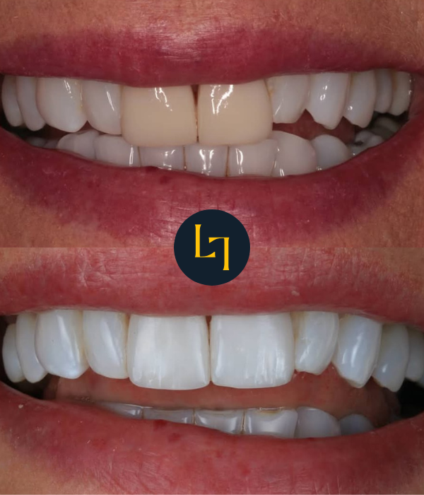 porcelain veneers before and after photo