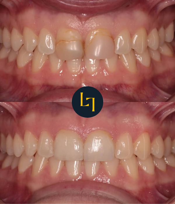 smile makeover before and after photo 2