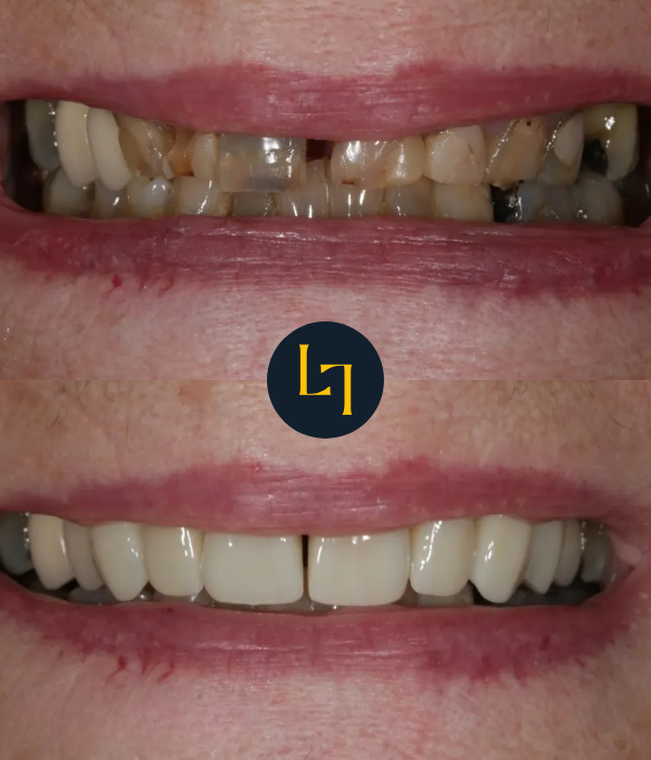 smile makeover in sheffield before and after photo 3