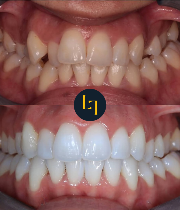 smile makeover in sheffield - photo before and after 1