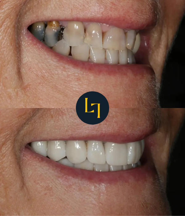 Close-up result after crowns — natural contours and comfortable bite