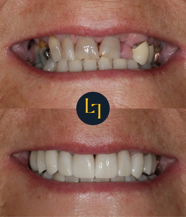 smile makeover zirconia crowns, emax veneers, and a zirconia bridge 2