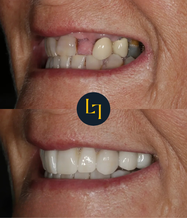 Before and after dental crowns Sheffield — smile makeover case