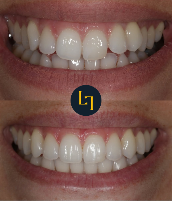 teeth straightening with Invisalign in sheffield before and after photo 1