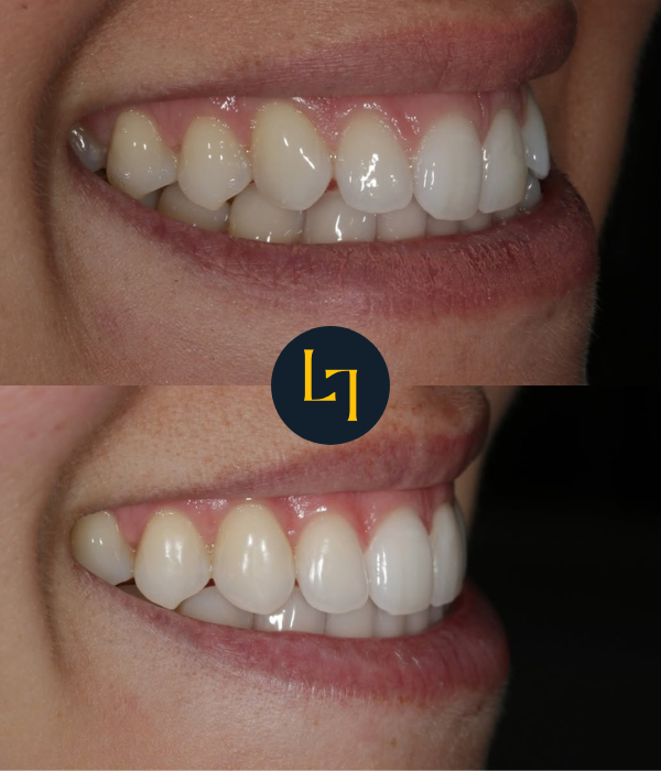 teeth straightening with Invisalign in sheffield before and after photo 2