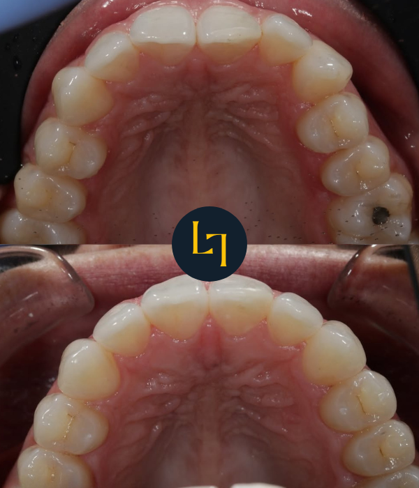 before and after teeth straightening in Sheffield - top half showing crooked, uneven teeth while the bottom part showing straight teeth after treatment - upper jaw photo