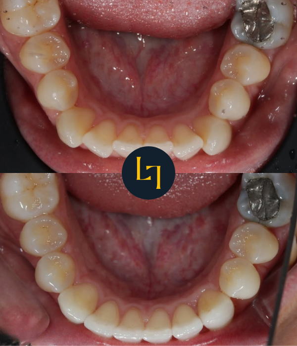 before and after teeth straightening in Sheffield - top half showing crooked, uneven teeth while the bottom part showing straight teeth after treatment - photo with the lower jaw