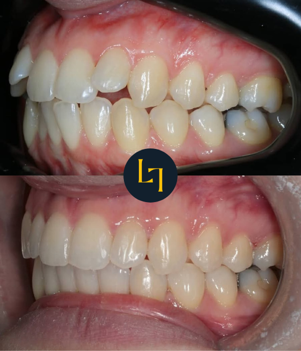 teeth straightening with Invisalign in sheffield before and after photo 5