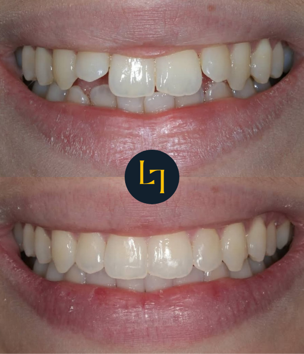 teeth straightening with Invisalign in sheffield before and after photo 6