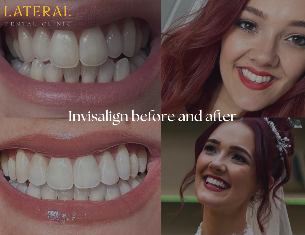 Invisalign before and after - straightening just in time for wedding case