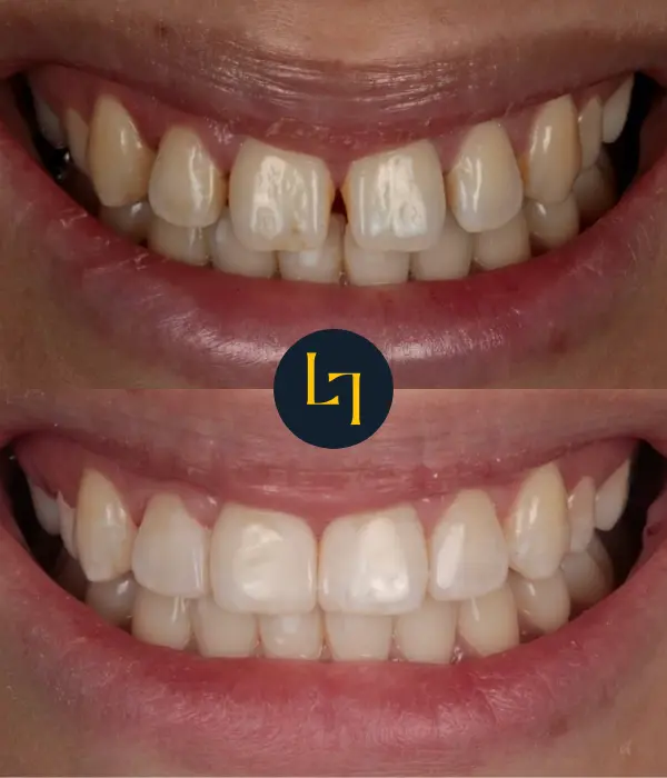 composite bonding - before and after results