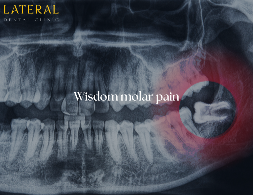 wisdom molar pain - what it can be done