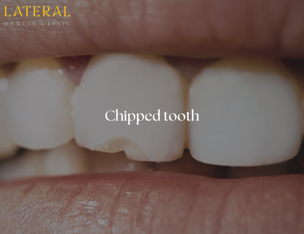 chipped tooth - what to do