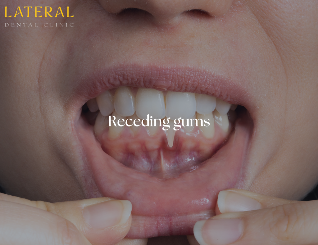 receding gums - how it looks