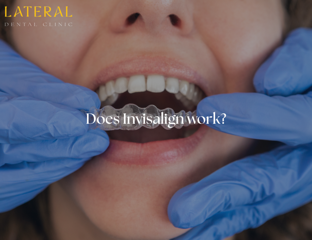 does invisalign really work